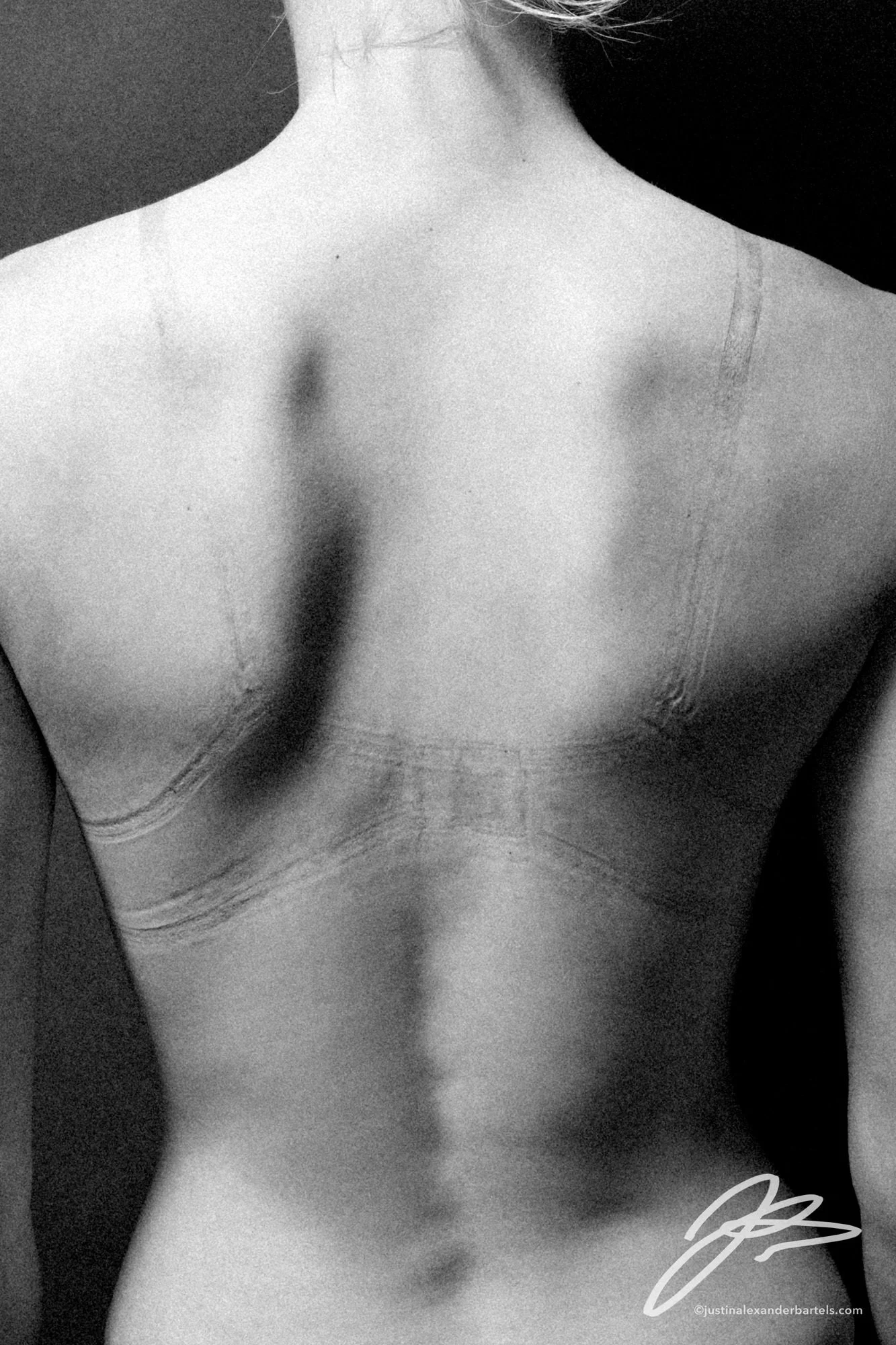 Bra Strap Burn
