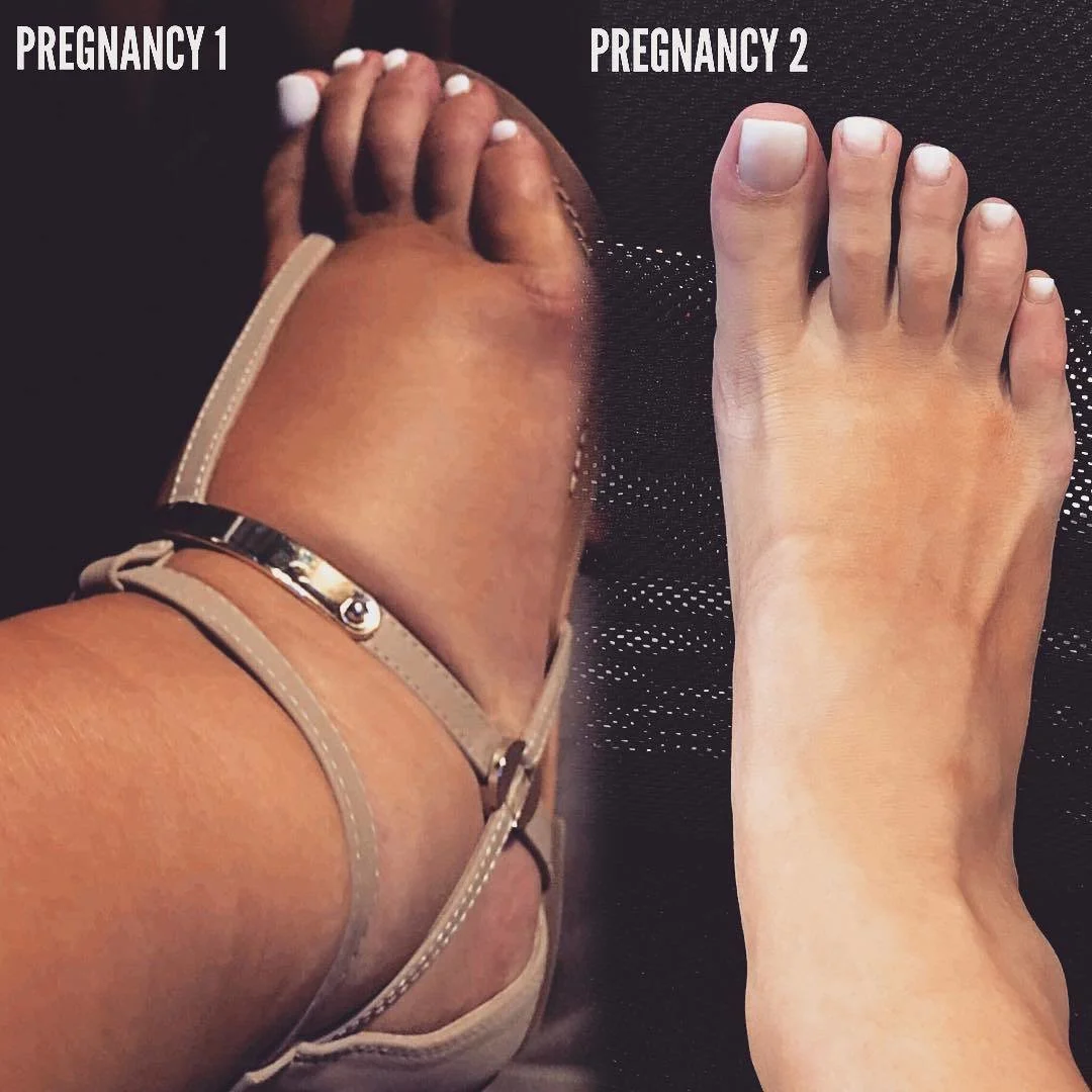 On the left is how swollen her feet got by the end of her first pregnancy, and the right is her foot at 39 weeks during her second pregnancy.