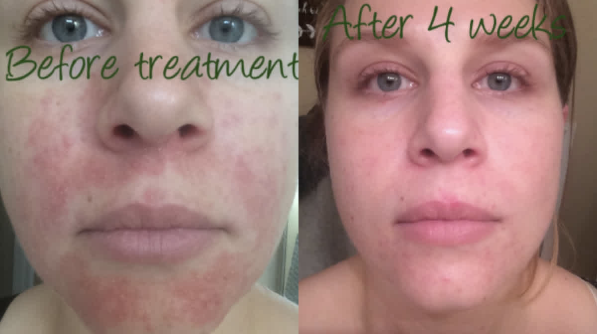 Woman Used Honey to Cure Her Severe Dermatitis Outbreak | CafeMom.com Woman Used Honey to Cure Her Severe Dermatitis Outbreak | CafeMom.com