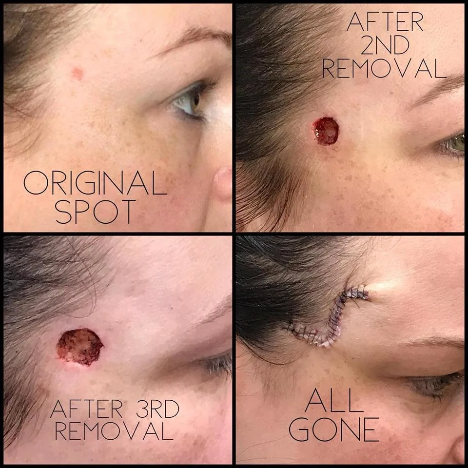 In a Facebook post, Jones, 40, shared how she's been recently diagnosed with basal cell carcinoma (BCC), one of the most common types of skin cancer.