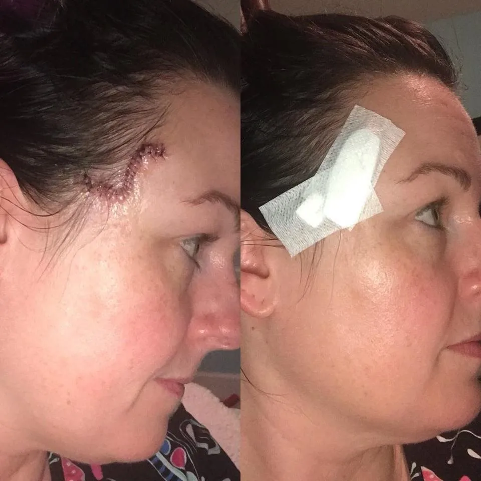 Her removal procedures left her with a nickel-sized hole in her head, which required 20 stitches.