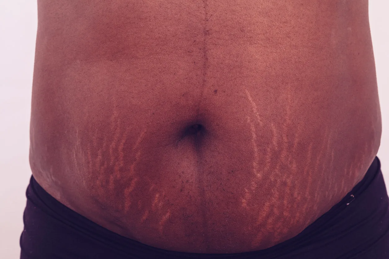 Stretch Marks