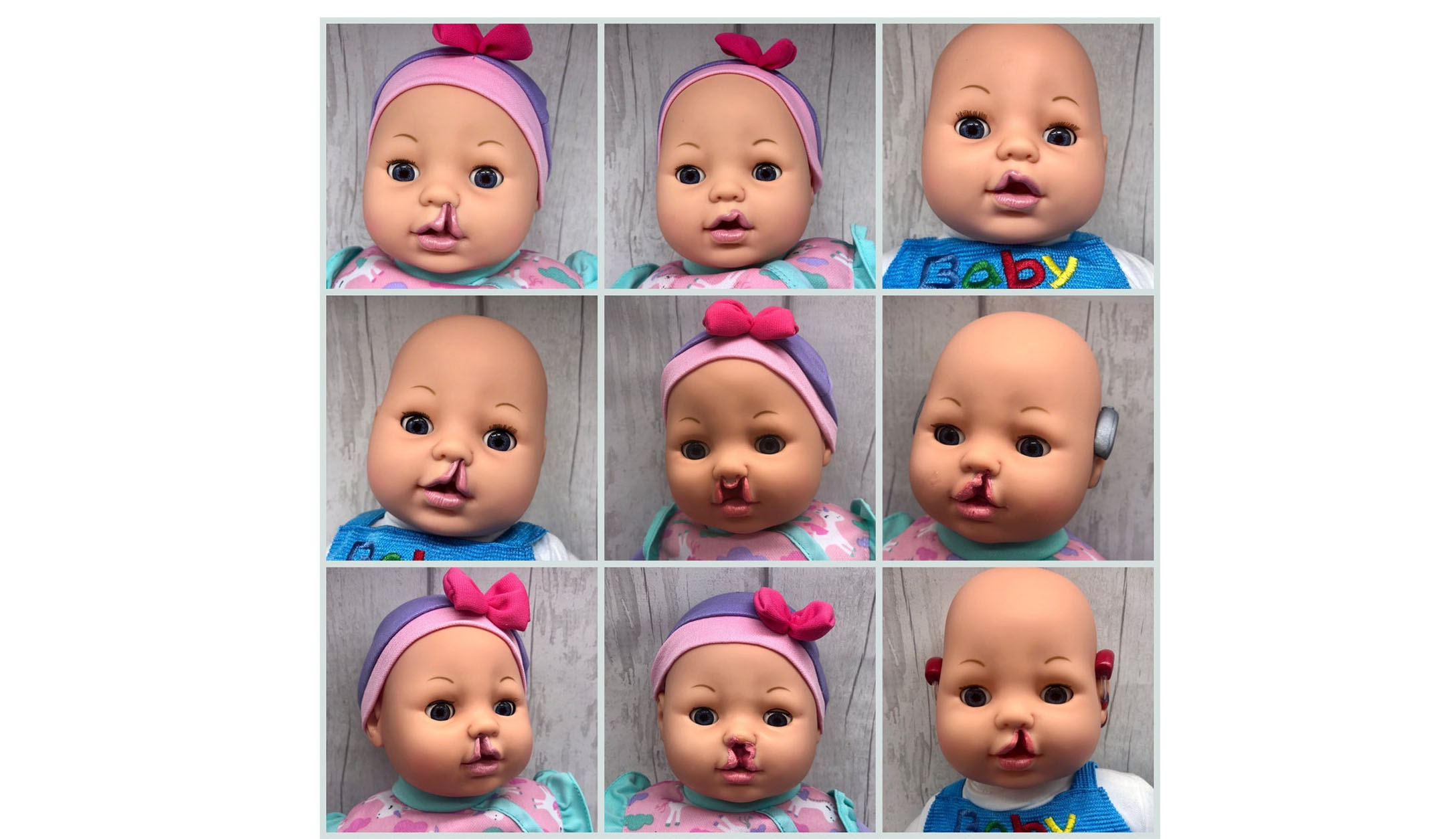 These Customizable 'Cleft Lip' Dolls Help Kids Feel Seen