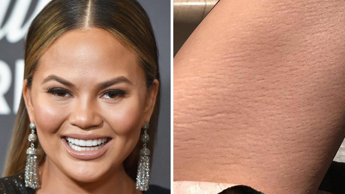 celebrities with stretch marks on hips