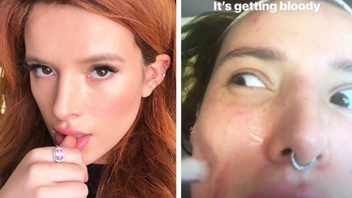 Bella Thorne Shared Her Bloody Secret For Getting Rid Of Acne Scars ...