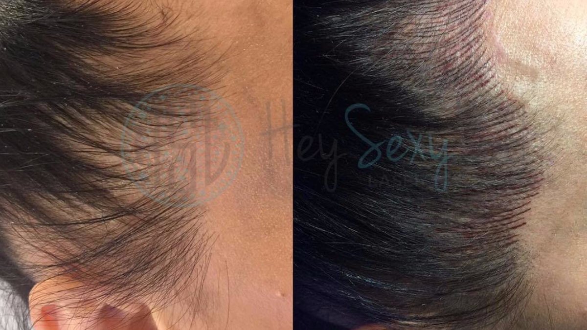 Scalp Micropigmentation Before and After  Hairline Hair Tattoo  SID   Scalp Ink Design