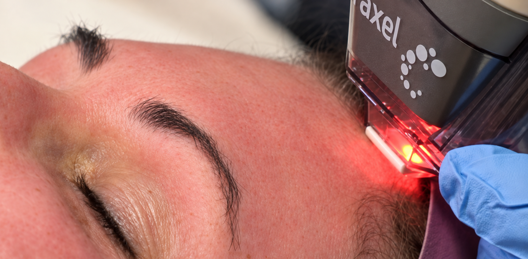 A close-up of the Fraxel laser working on a woman's forehead