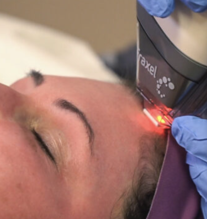 Clear + Brilliant: The Low-Downtime Laser That Actually Delivers