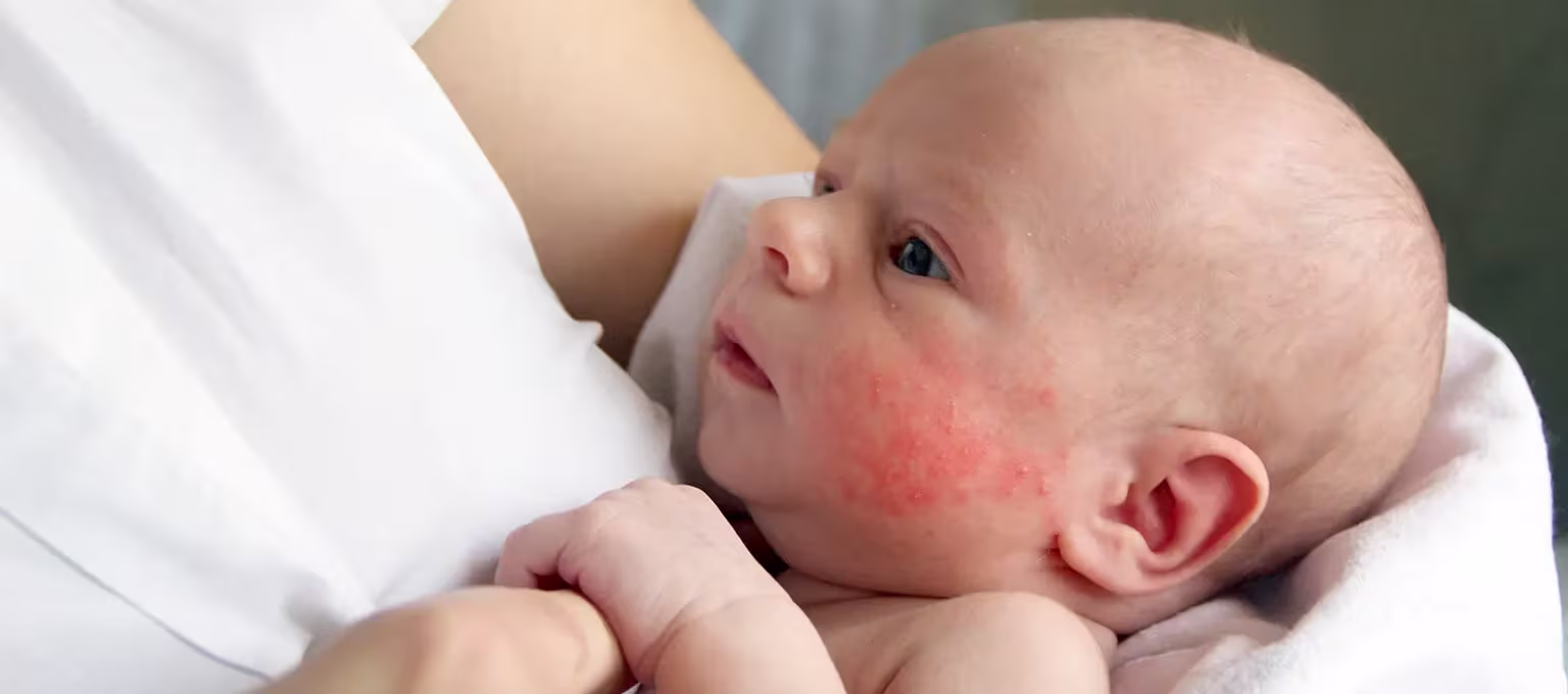 Newborn baby dry skin