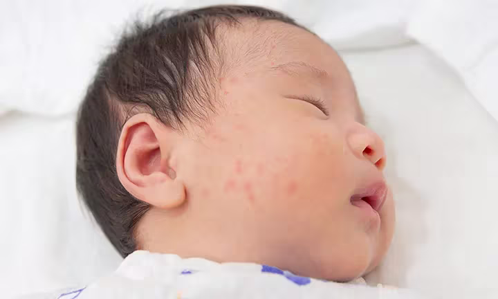 Banner Image of Baby with Hives for Article on Baby Hives: Symptoms, Causes, and Treatments