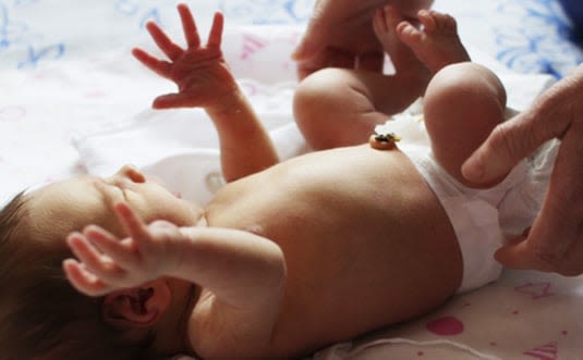 Umbilical Cord Care