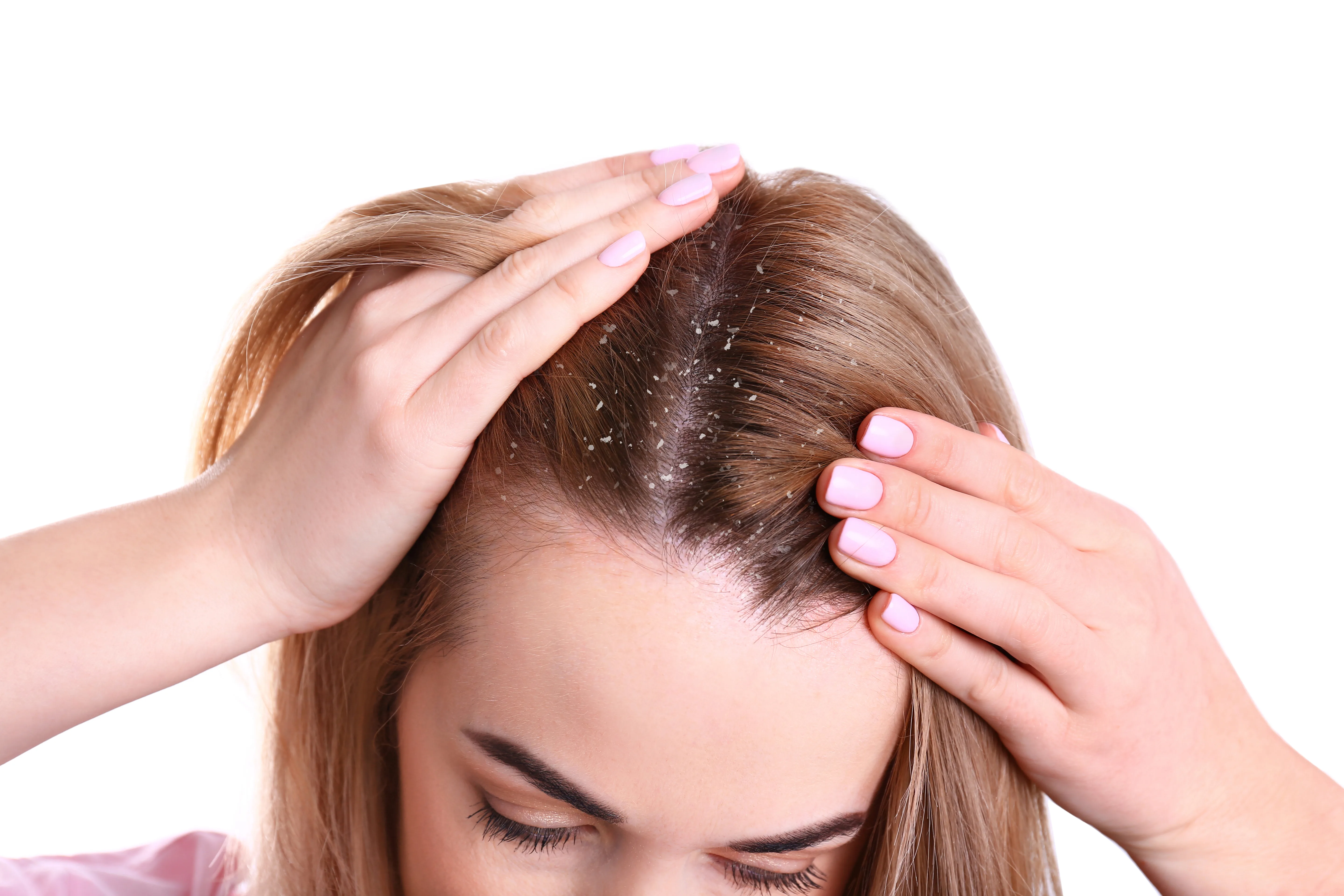 Woman with Dandruff Problems