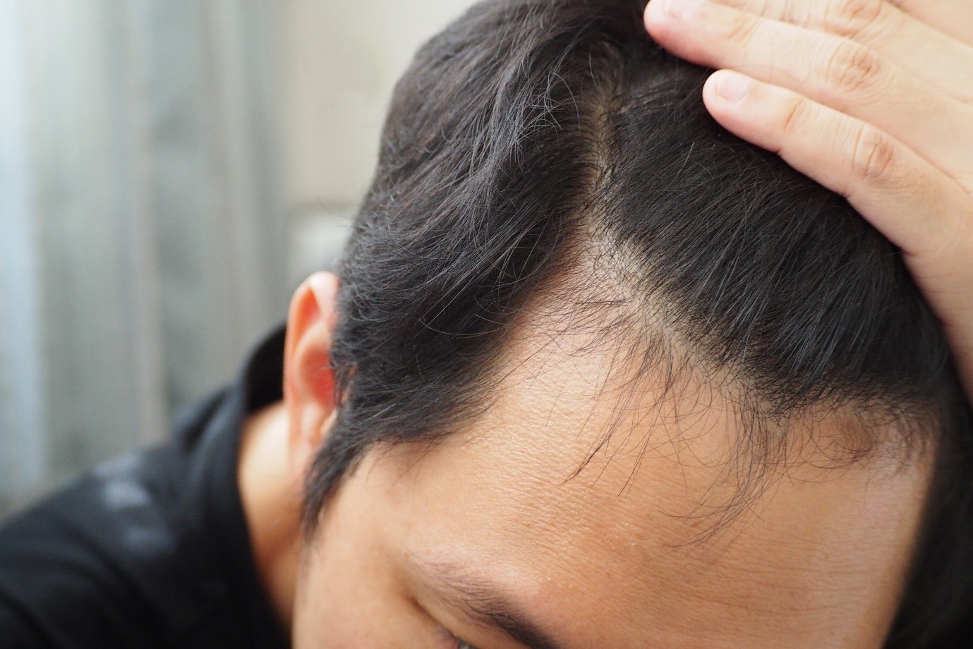 Best treatment for hair store loss men