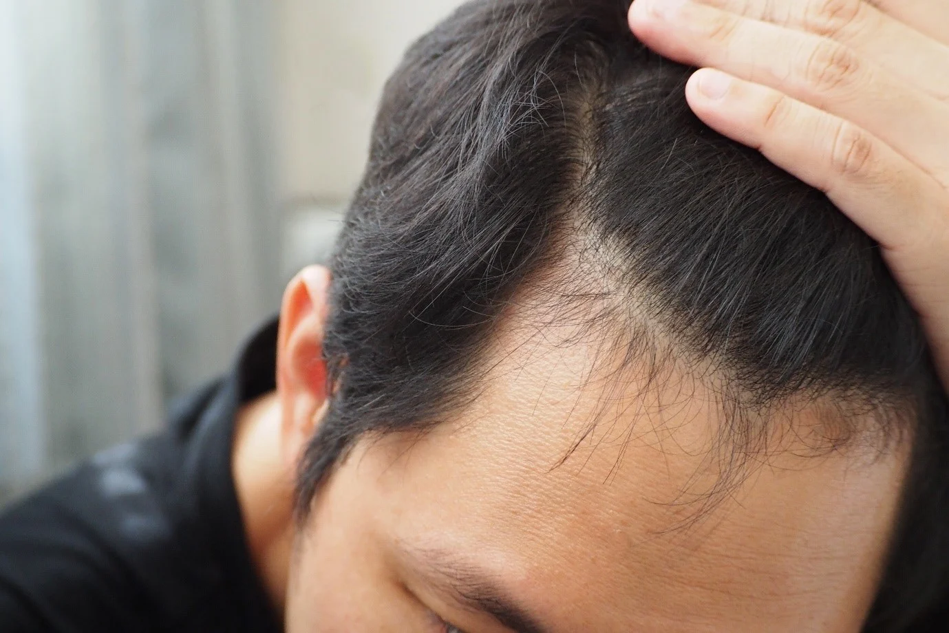 Hair fall treatment for men