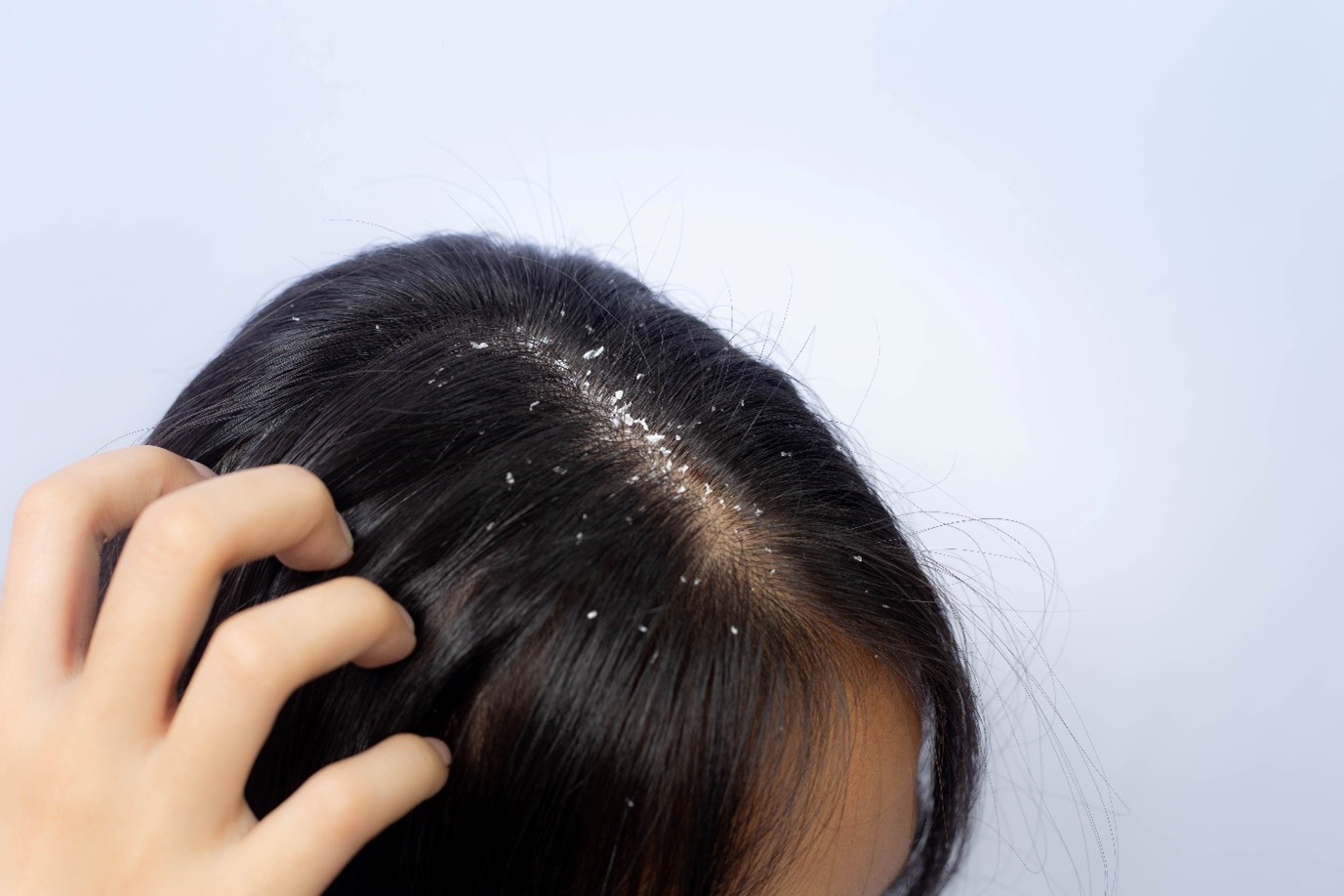 199 Hair Skin Trouble Dandruff Stock Photos - Free & Royalty-Free Stock  Photos from Dreamstime