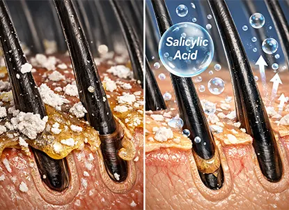 Close-up of scalp with visible flakes and oil buildup, highlighting salicylic acid gently exfoliating and clearing dandruff.
