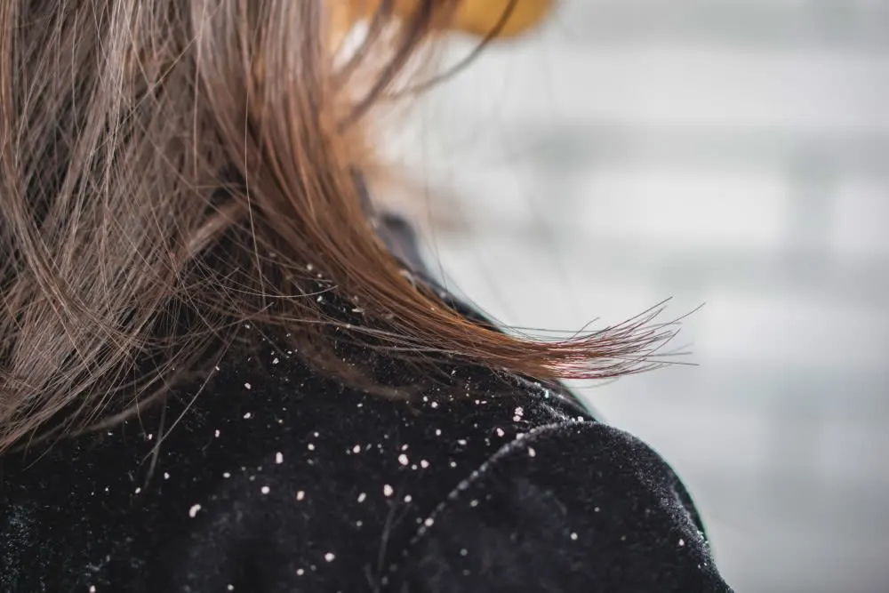 Everything About Dandruff