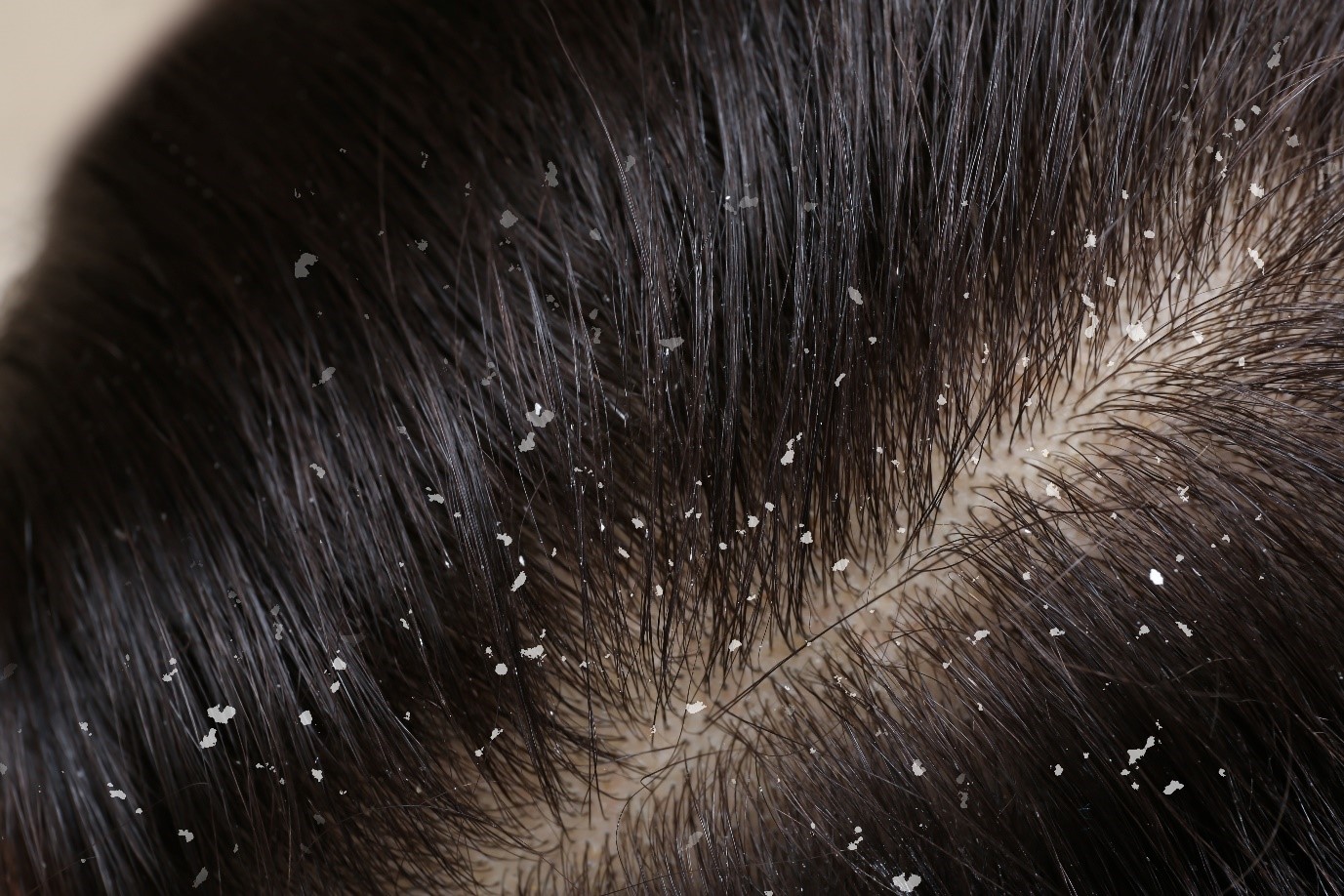 White Piedra Vs Dandruff Causes and Prevention H S India