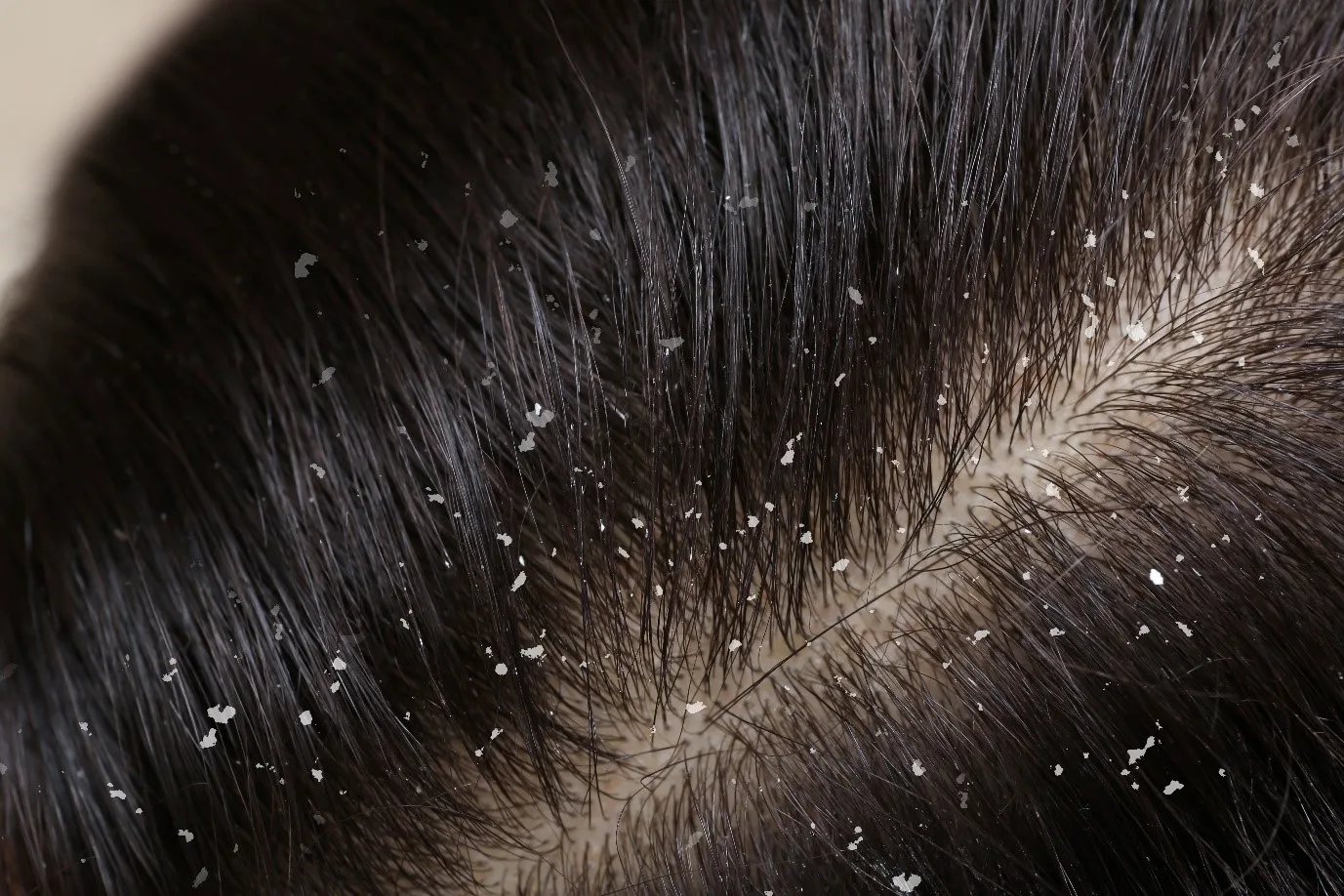 Lice vs. Dandruff: How to Tell the Difference