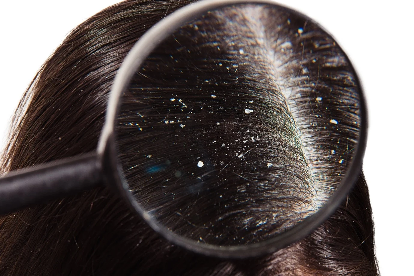 Looking for Dandruff Through Magnifying Glass