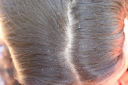 Really Bad Dandruff Problem