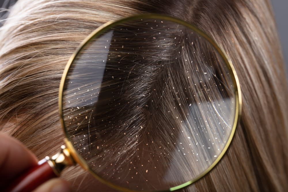 Know The Different Types Of Dandruff