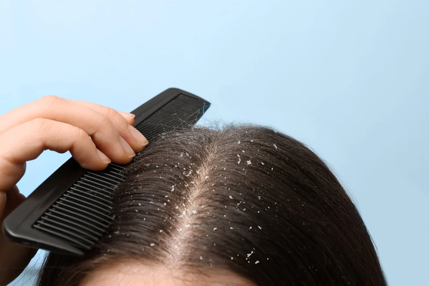 Woman combing hair full of dandruff