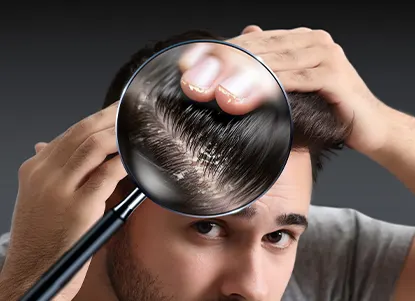 A close-up of a scalp with visible oil and sticky flakes transitioning into a refreshed, clean scalp to illustrate oily dandruff causes and treatment.