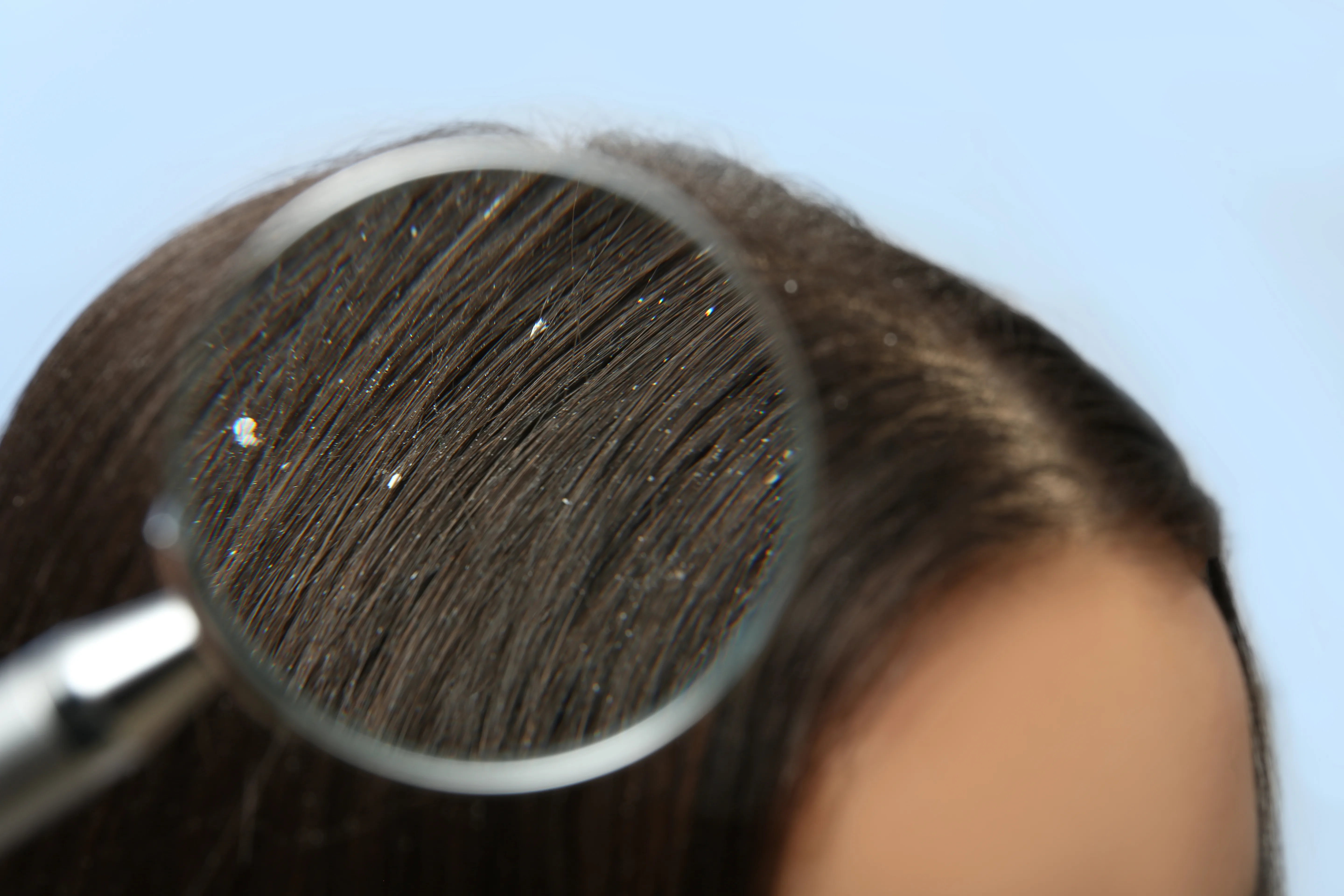 Malassezia Globosa - The Cause Of Dandruff