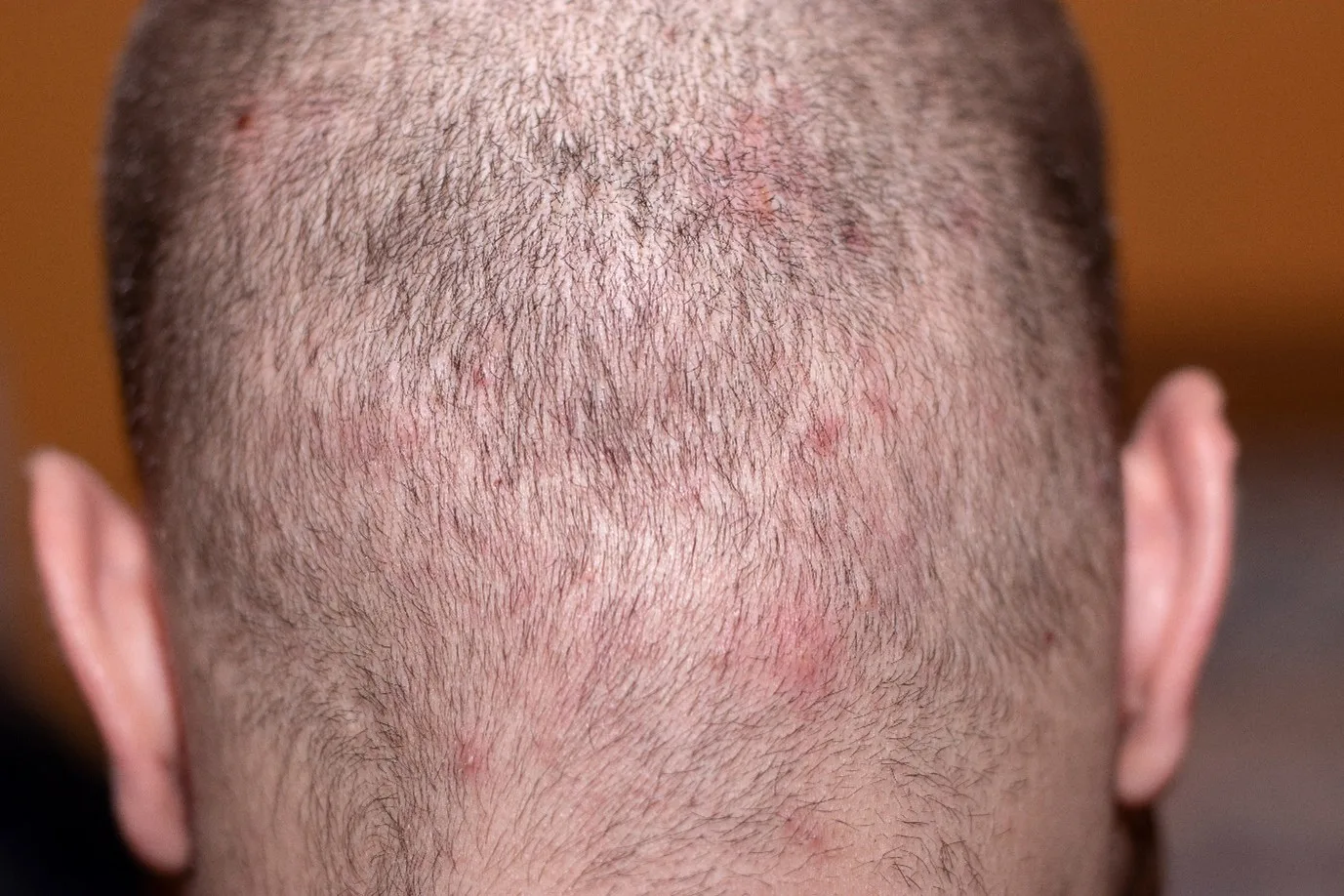 Tinea Capitis :Symptoms, Causes and Treatment | Head & Shoulders IN