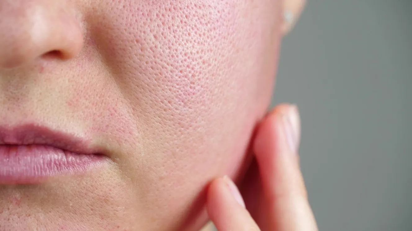 Women having large pores caused by sebum fluctuation