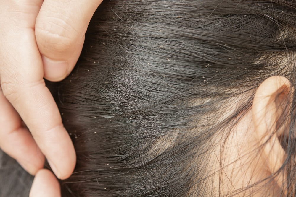 lice eggs or dandruff