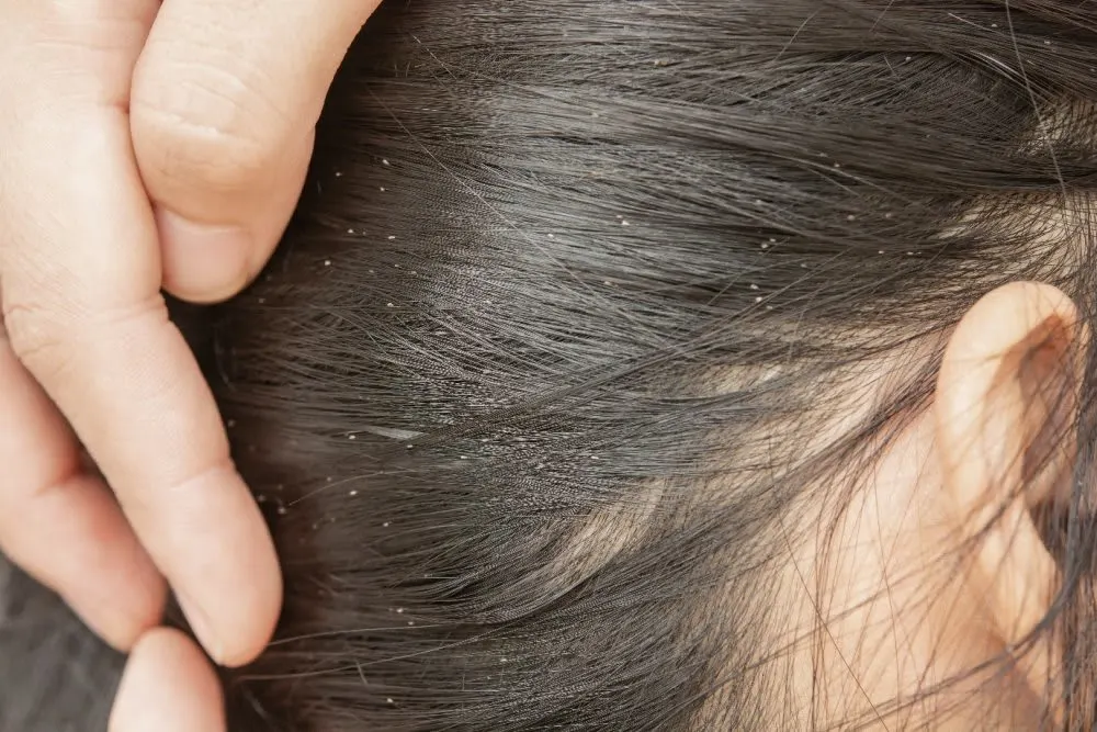 DO YOU HAVE LICE OR DANDRUFF?