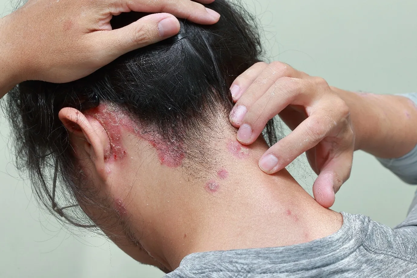 Woman with Scalp Psoriasis