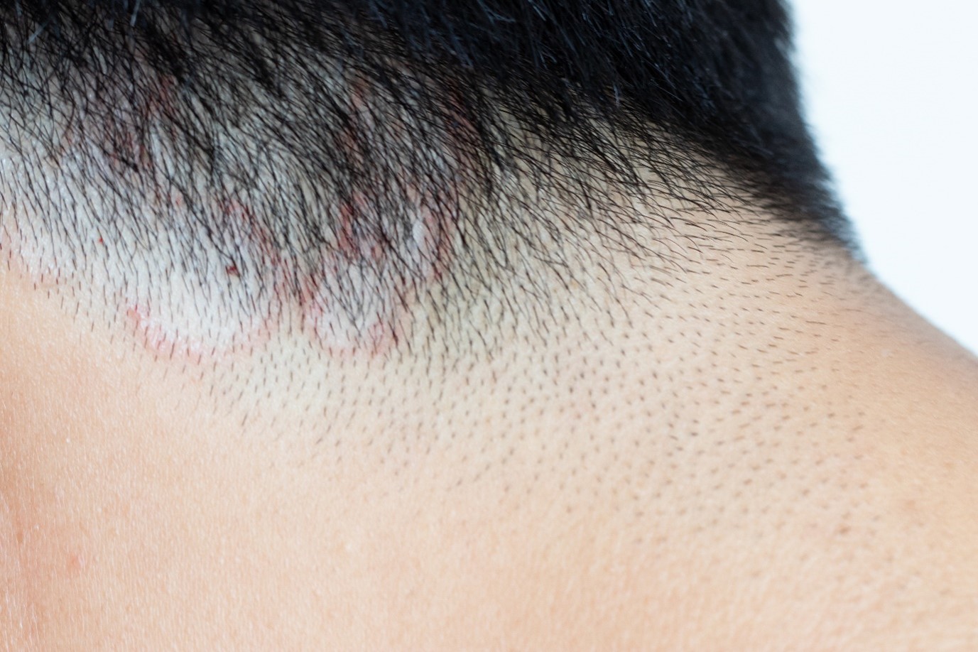 Man suffering from tinea versicolor