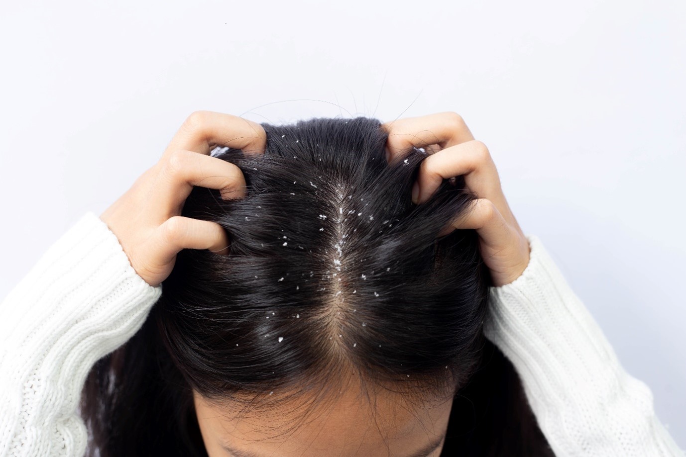 Woman with dandruff in her hair