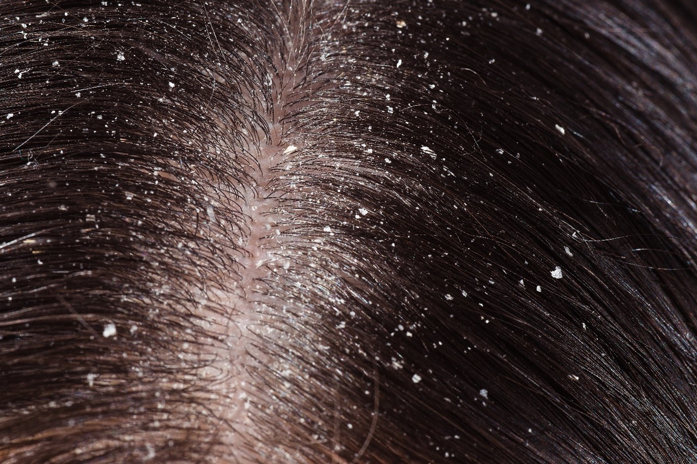 Scalp that is dry and full of dandruff