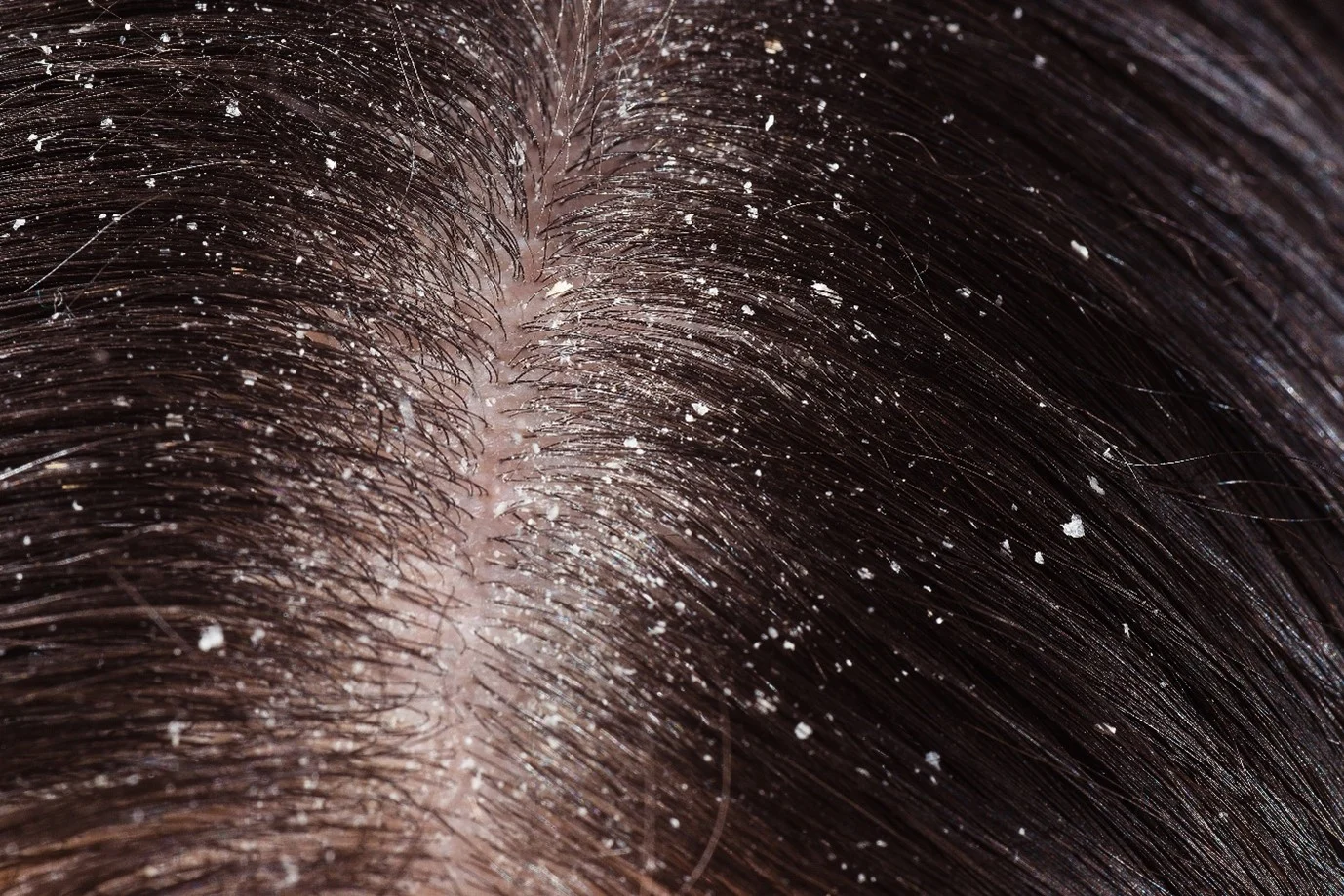 Dry Scalp and What Causes It? | Head & Shoulders IN