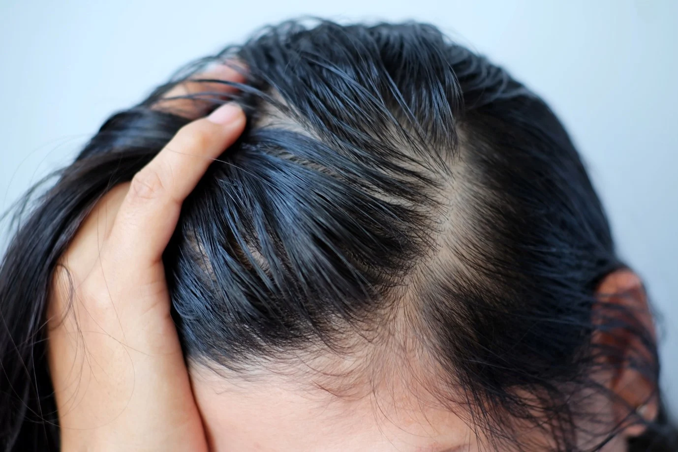 Oily Scalp in Summers: Causes and Tips to Cure it| Head & Shoulders IN