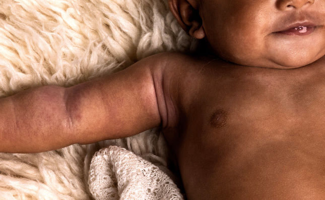 An adorable baby rests on a cozy blanket, with one arm opened highliting an itchy condition on it