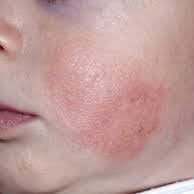 Skin isue 2 (1)