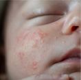 ECZEMA PRONE 