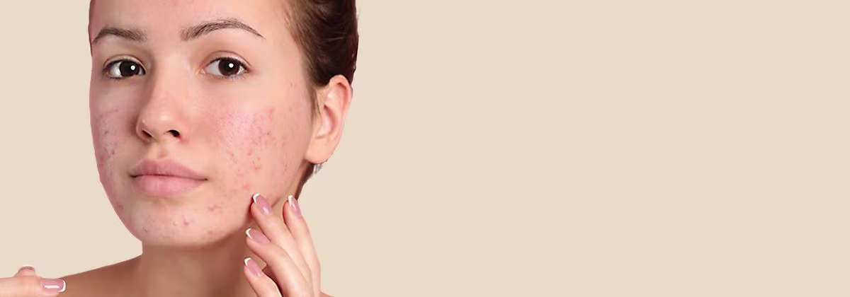 Image focusing a face of a woman with acne, highlighting a moment of self care