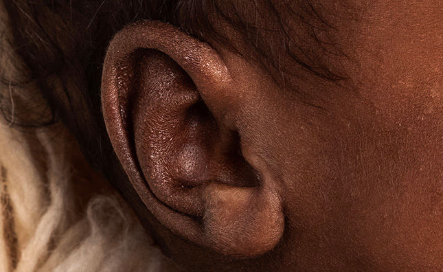 Close-up image of a child's ear, showing a skin condition texture in detail