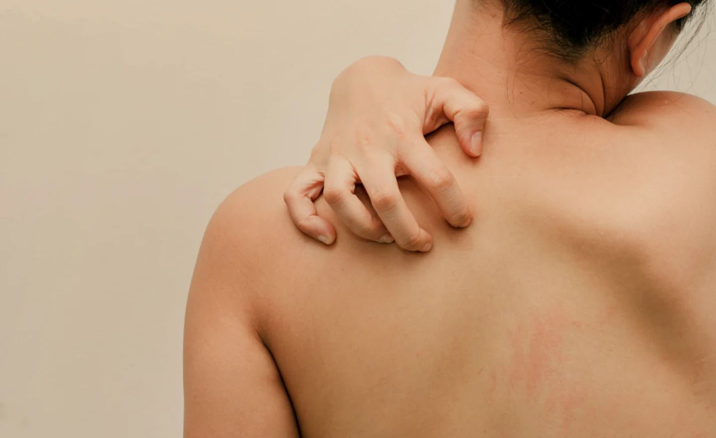A woman scratching her left back, showing slight redness on her skin