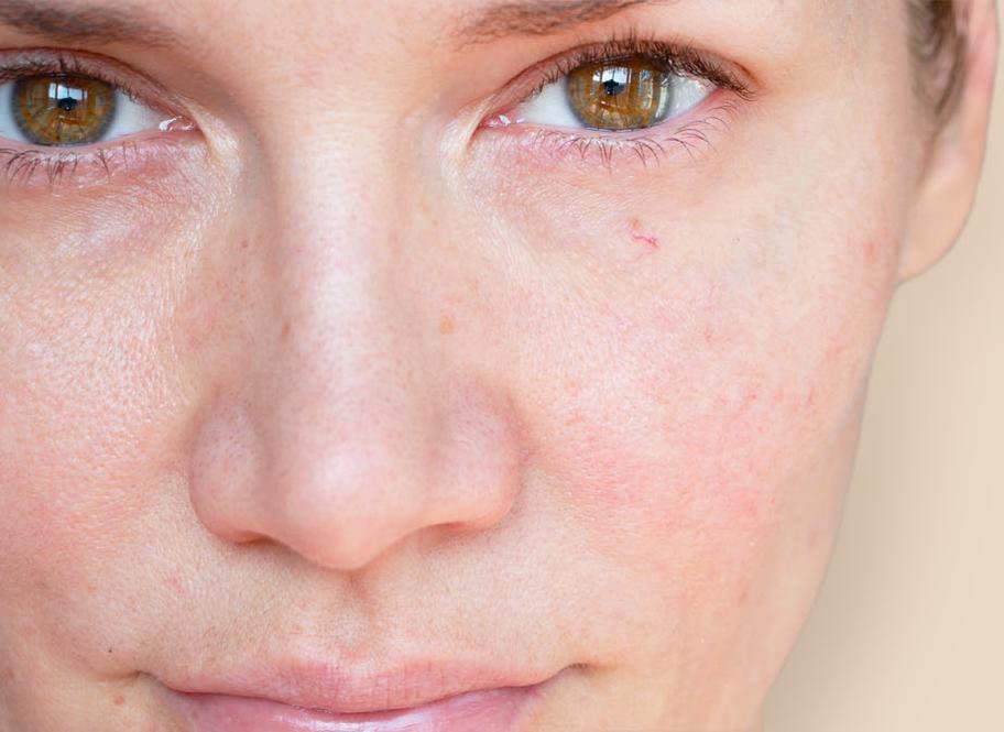 A woman with visible redness on her face, showcasing her natural skin texture and features
