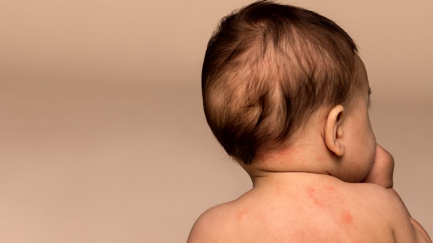 A baby sitting up facing away and back showing irritated skin.