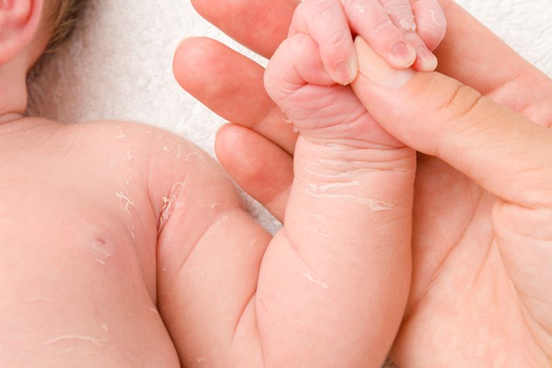 Sedih Melihat Kulit Bayi Kering & Mengelupas? Jangan Khawatir, Ada Solusinya! - Hero Image