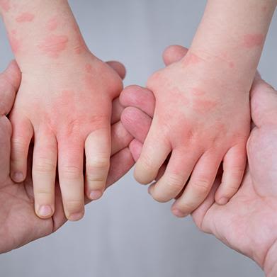 Eczema: