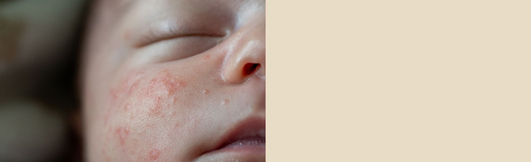 eczema_banner-en-au-Aveeno